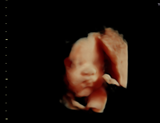 3D ultrasound image at 29 weeks